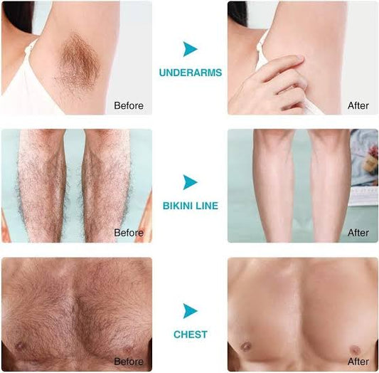 Sydonic hair Removal Treatment