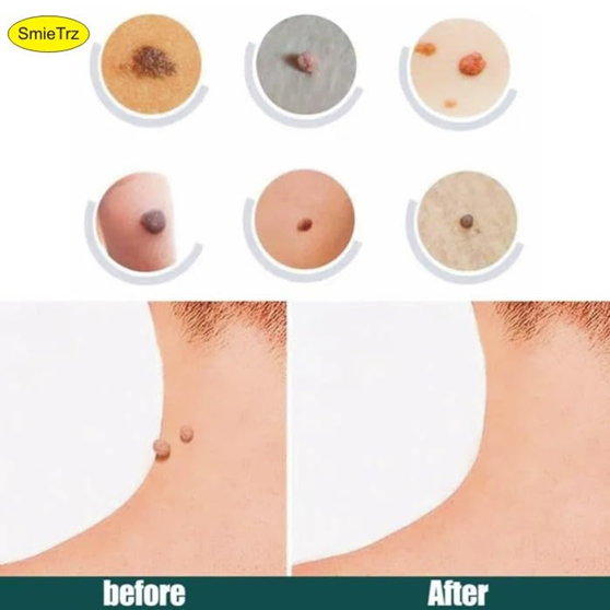 Dermasmooth Skin Tag Remover Patch