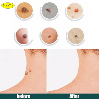 Dermasmooth Skin Tag Remover Patch