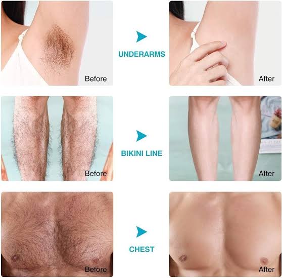 Sydonic hair Removal Treatment