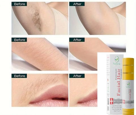 Sydonic hair Removal Treatment