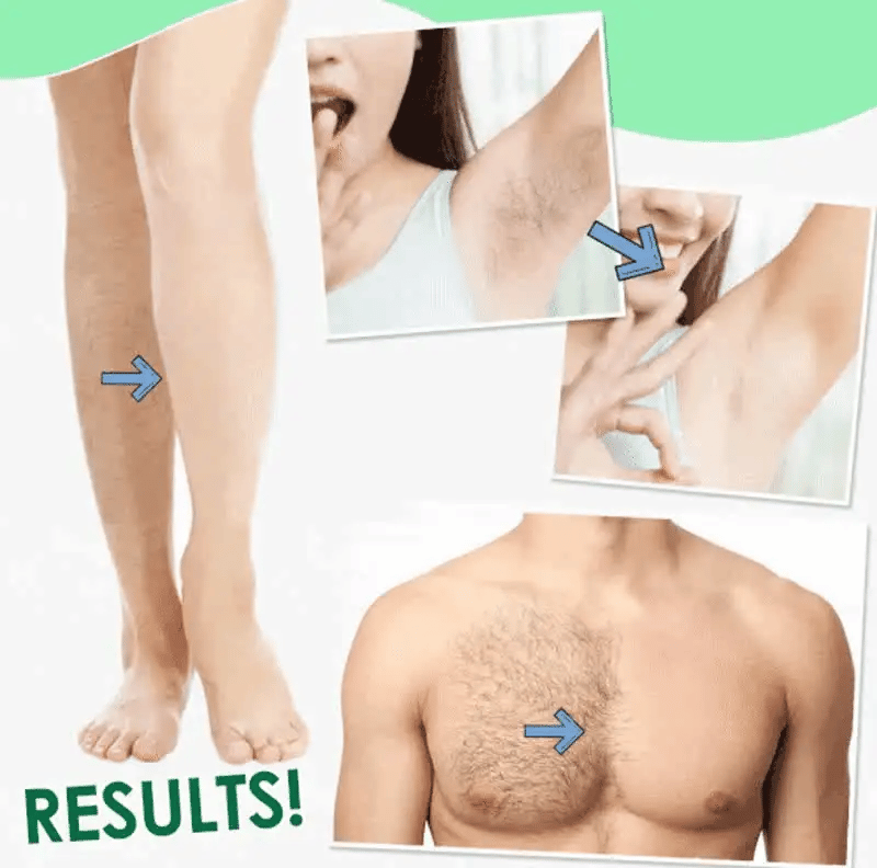 Sydonic hair Removal Treatment